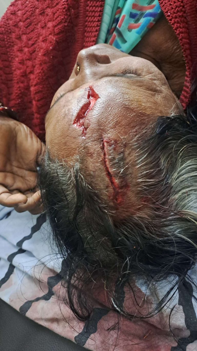 ब्रेकिंग…! अष्टापुरात बिबट्याचा महिलेवर हल्ला अंजना कोतवाल गंभीर जखमी