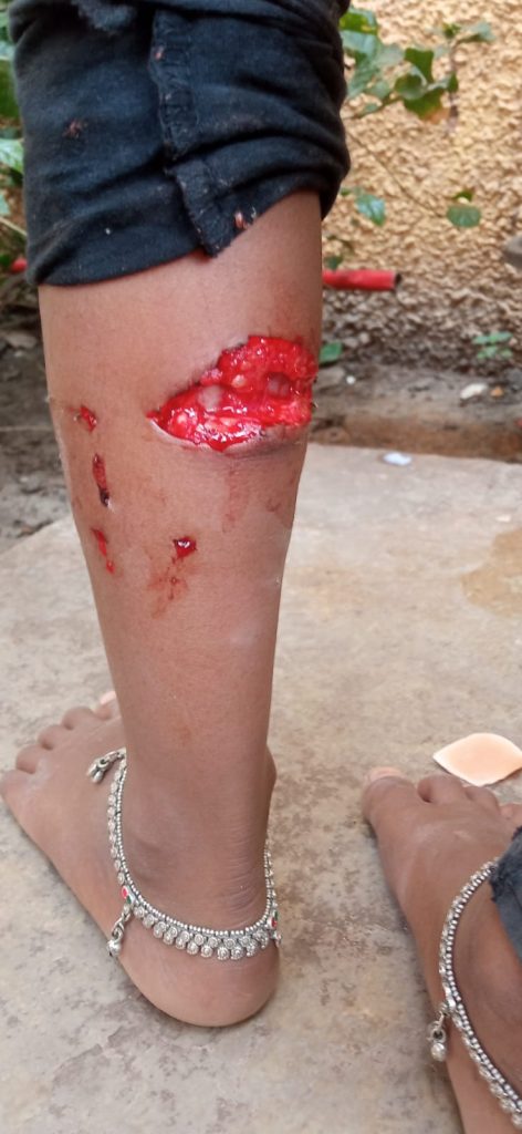 पंढरीनाथ नगर मध्ये भटक्या कुत्र्यांचा सुळसुळाट कुत्र्यांच्या हल्ल्यामध्ये लहान मुलगी गंभीर जखमी